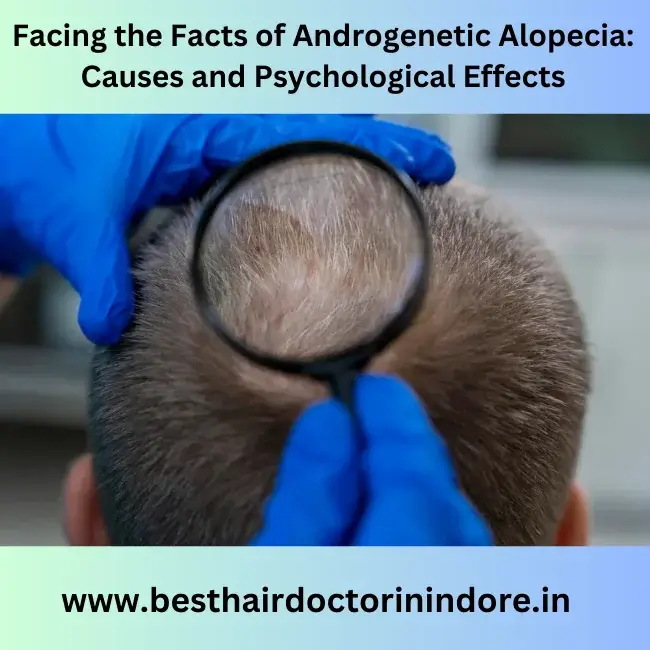 alopecia treatment in Indore