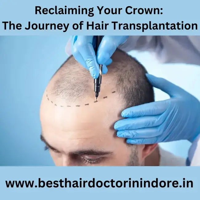 Hair Transplantation