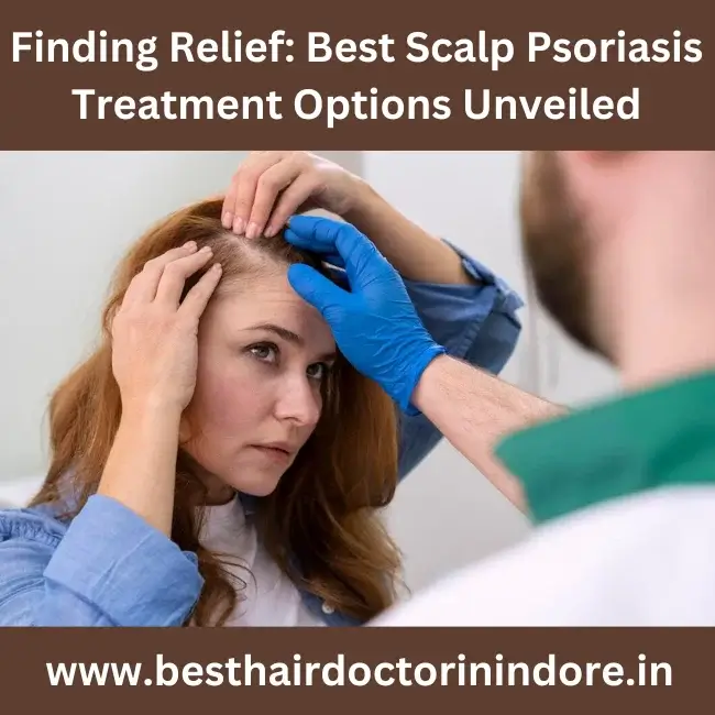 Finding Relief: Best Scalp Psoriasis Treatment Options Unveiled