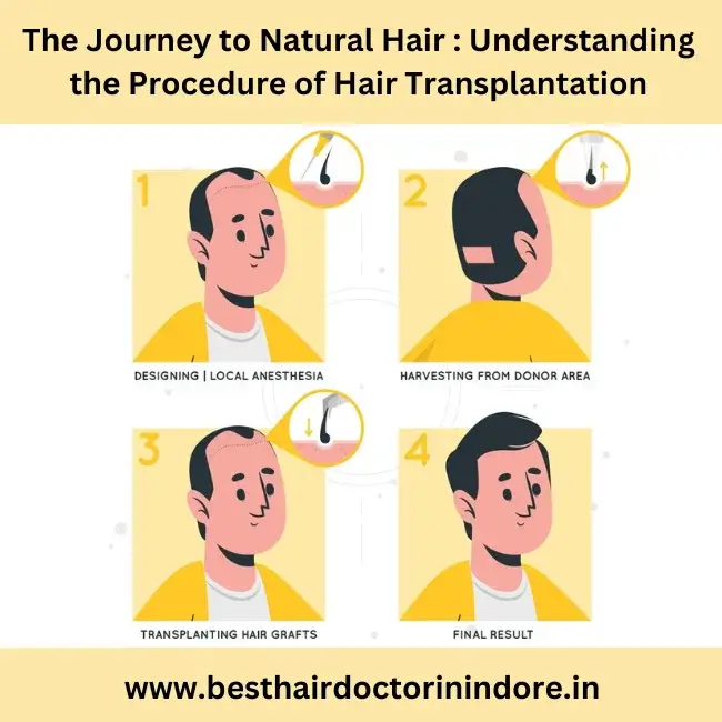 hair transplantation in Indore