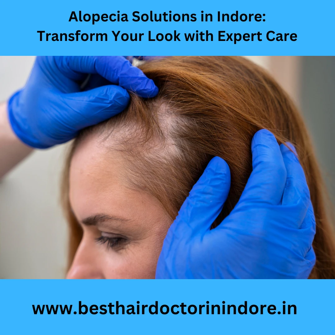 Best Alopecia Treatment in Indore