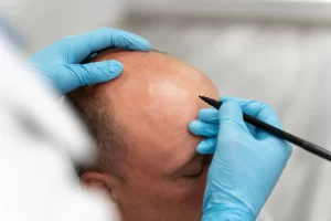 Best Alopecia Treatment in Indore