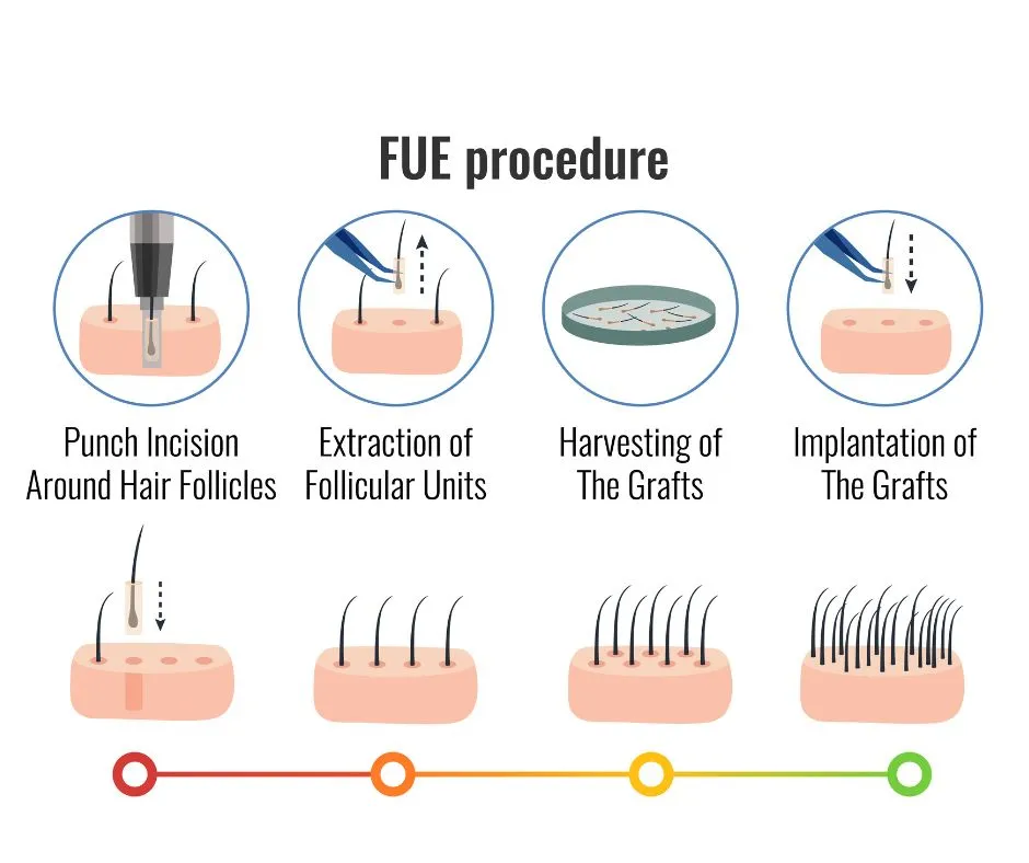 hair transplantation in Indore