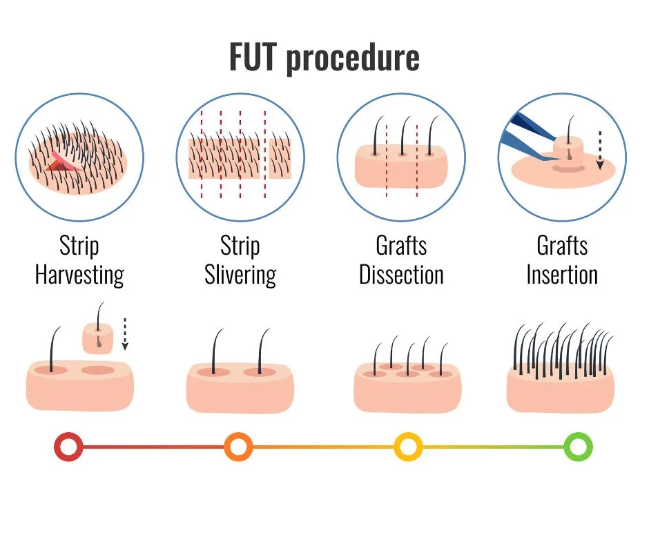 hair transplantation in Indore