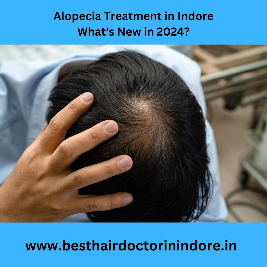 alopecia treatment in Indore