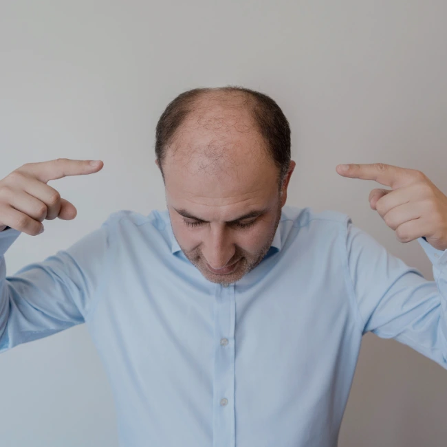 Hair Patch in Indore for Bald Spots