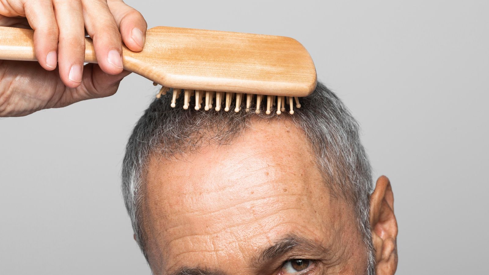 alopecia treatment in Indore