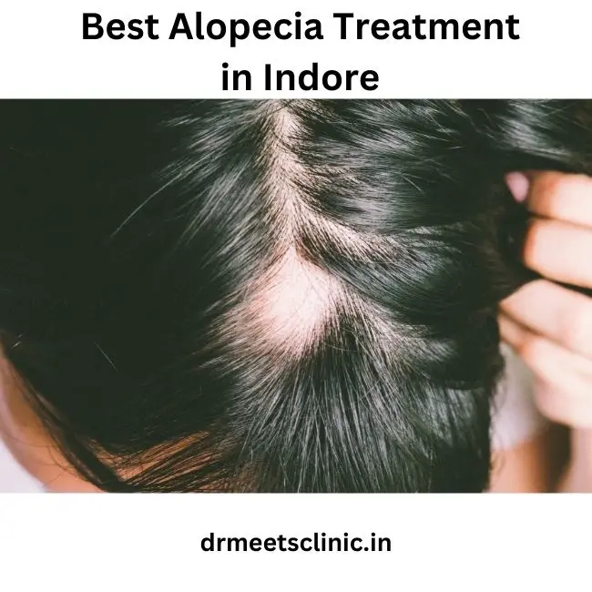 Best Alopecia Treatment in Indore