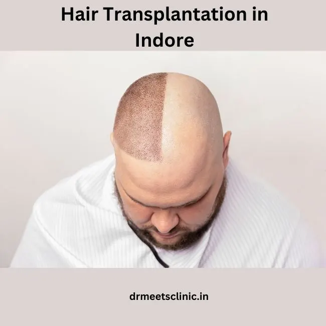 hair transplantation in Indore