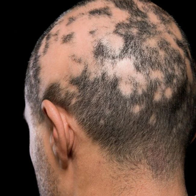 alopecia treatment in Indore