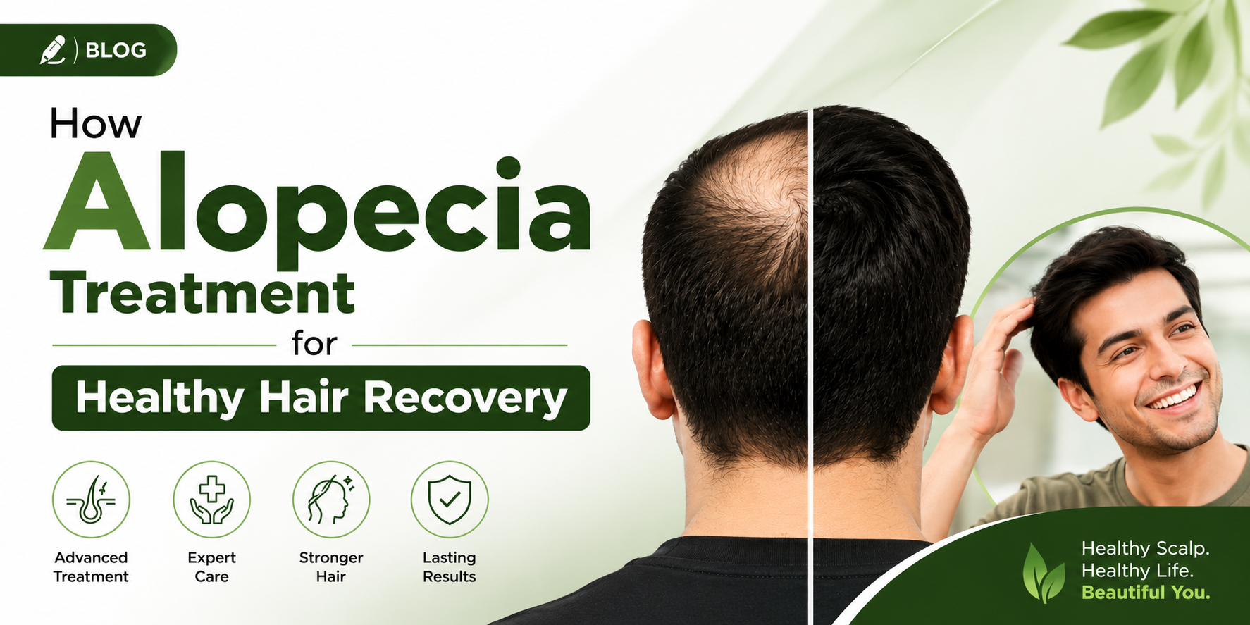 Alopecia Treatment in Indore